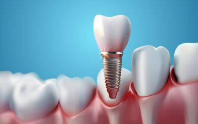 Challenge of Converting Leads into Dental Implant Treatments